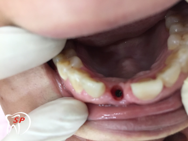 IMG_0146 Implant riêng lẻ