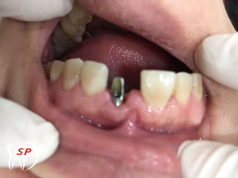 Implant riêng lẻ Implant riêng lẻ