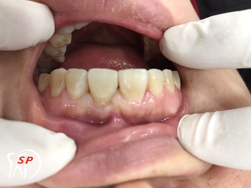 Implant riêng lẻ3 Implant riêng lẻ