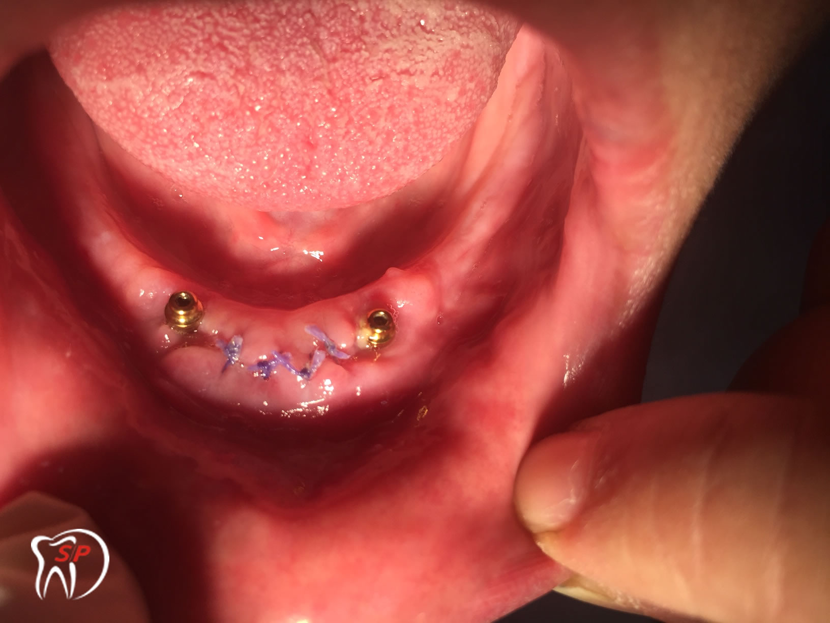 Kỹ thuật dùng 2 Implant-codinh Implant riêng lẻ