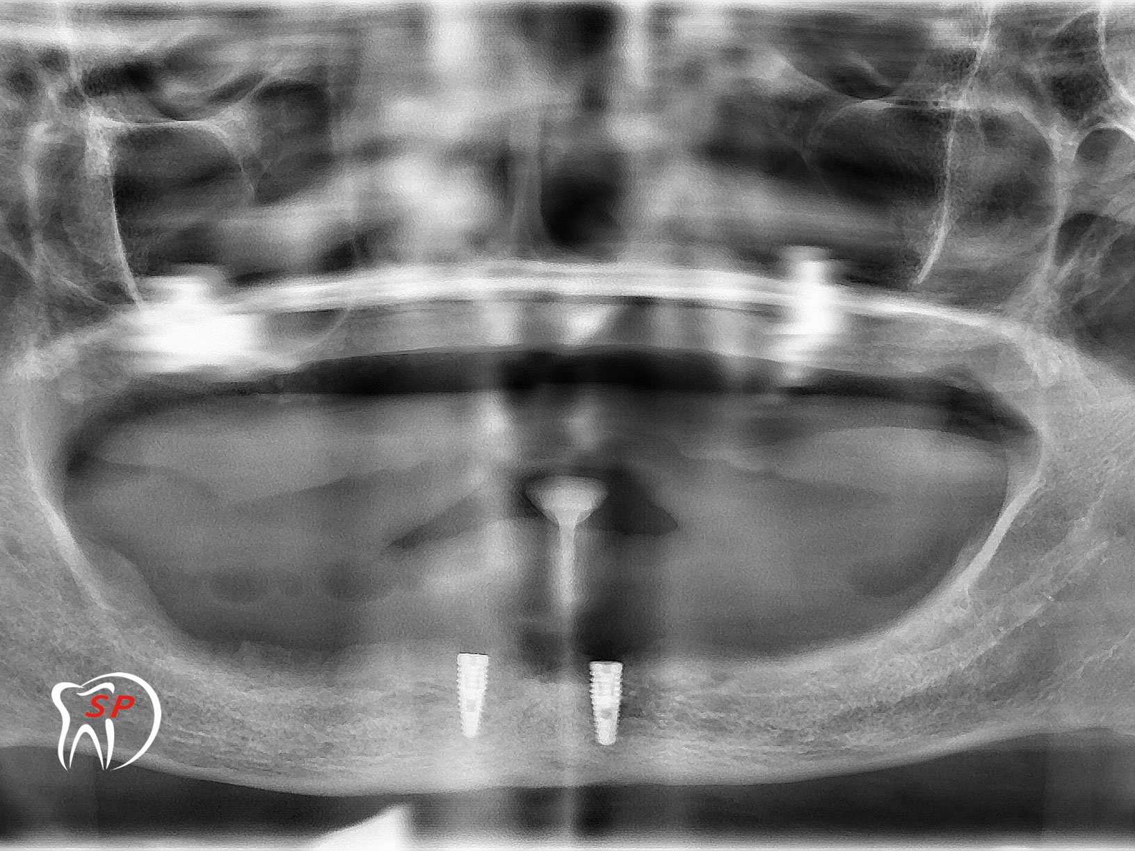 Kỹ thuật dùng 2 Implant3 Implant riêng lẻ