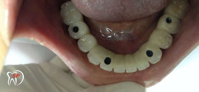 Kỹ thuật dùng 4 Implant1 Implant riêng lẻ