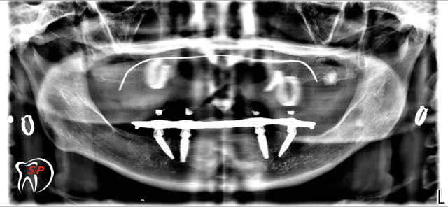 Kỹ thuật dùng 4 Implant2 Implant riêng lẻ
