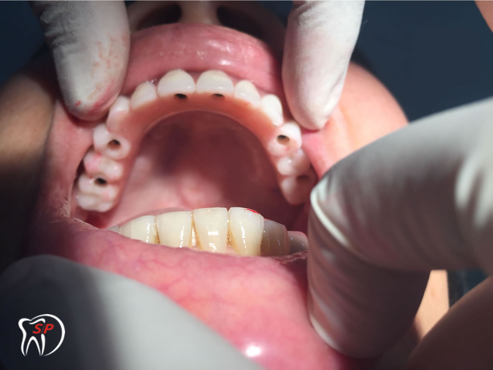Kỹ thuật dùng 6 Implant Implant riêng lẻ