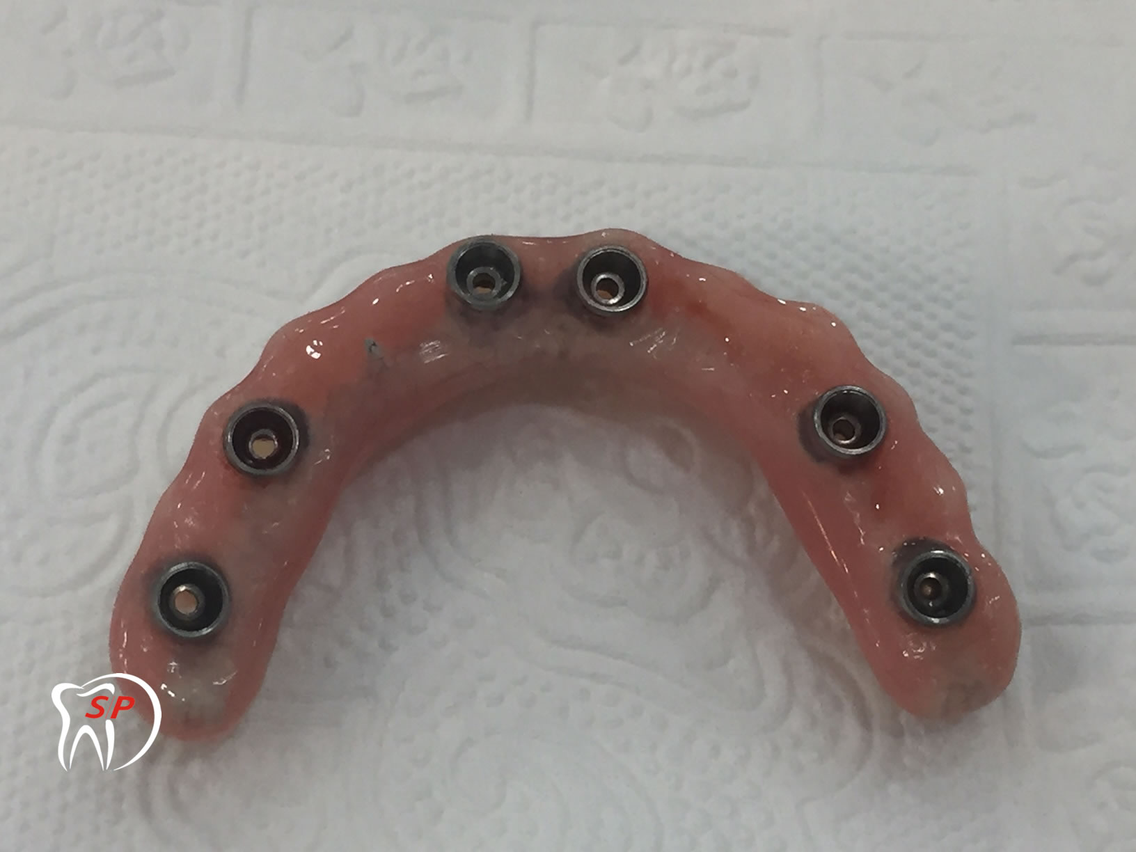 Kỹ thuật dùng 6 Implant2 Implant riêng lẻ