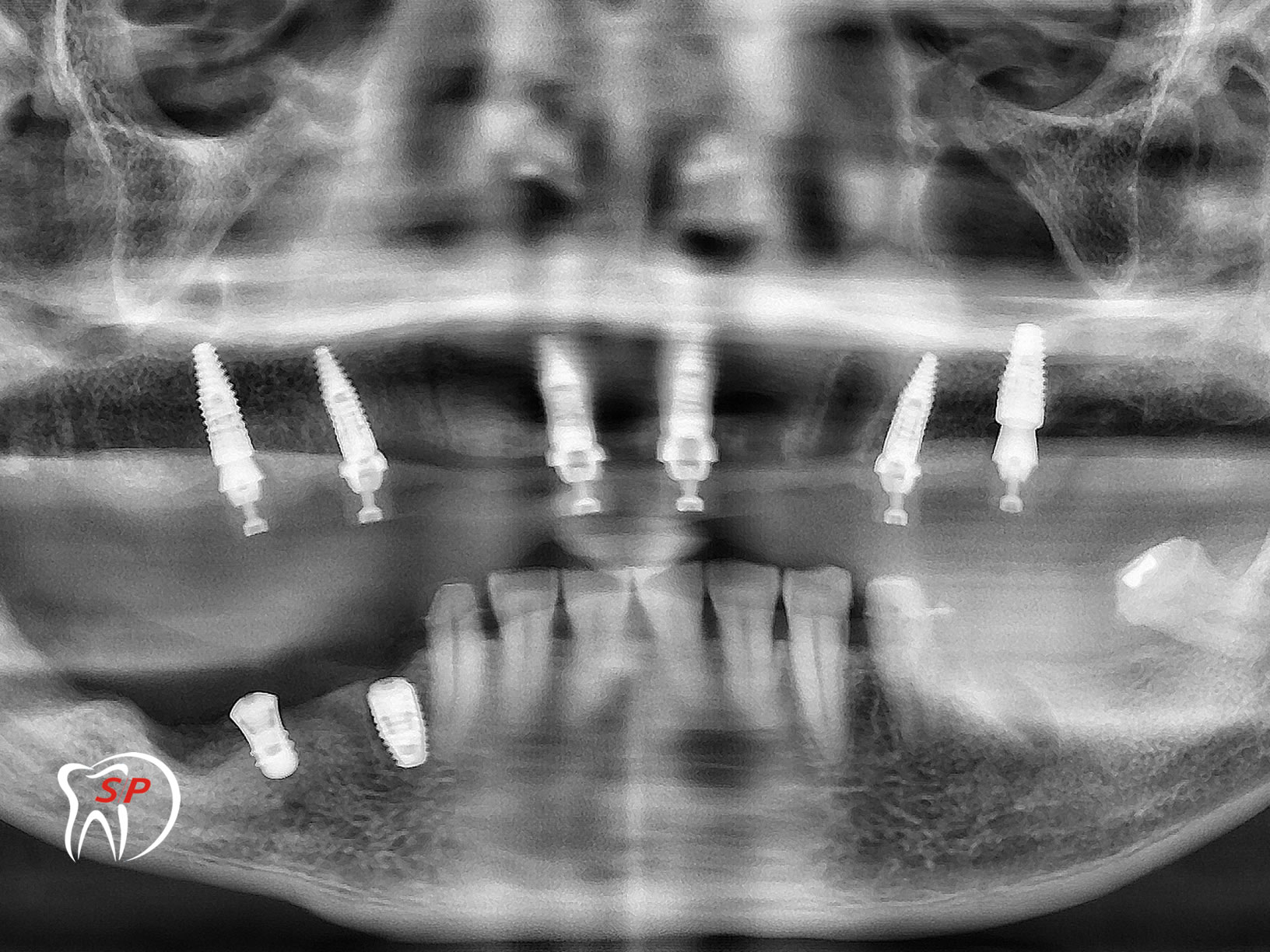 Kỹ thuật dùng 6 Implant3 Implant riêng lẻ