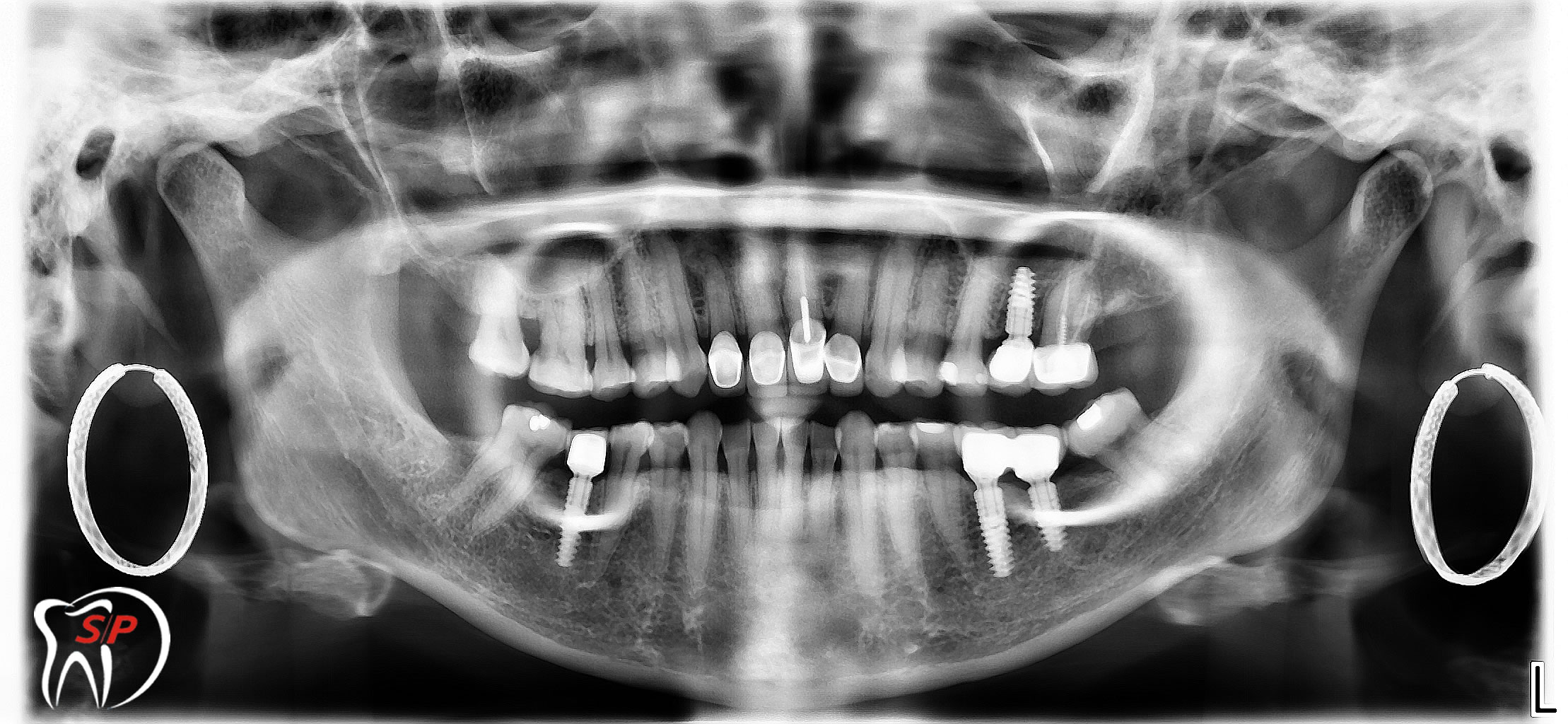 Nhiều Implant1 Implant riêng lẻ