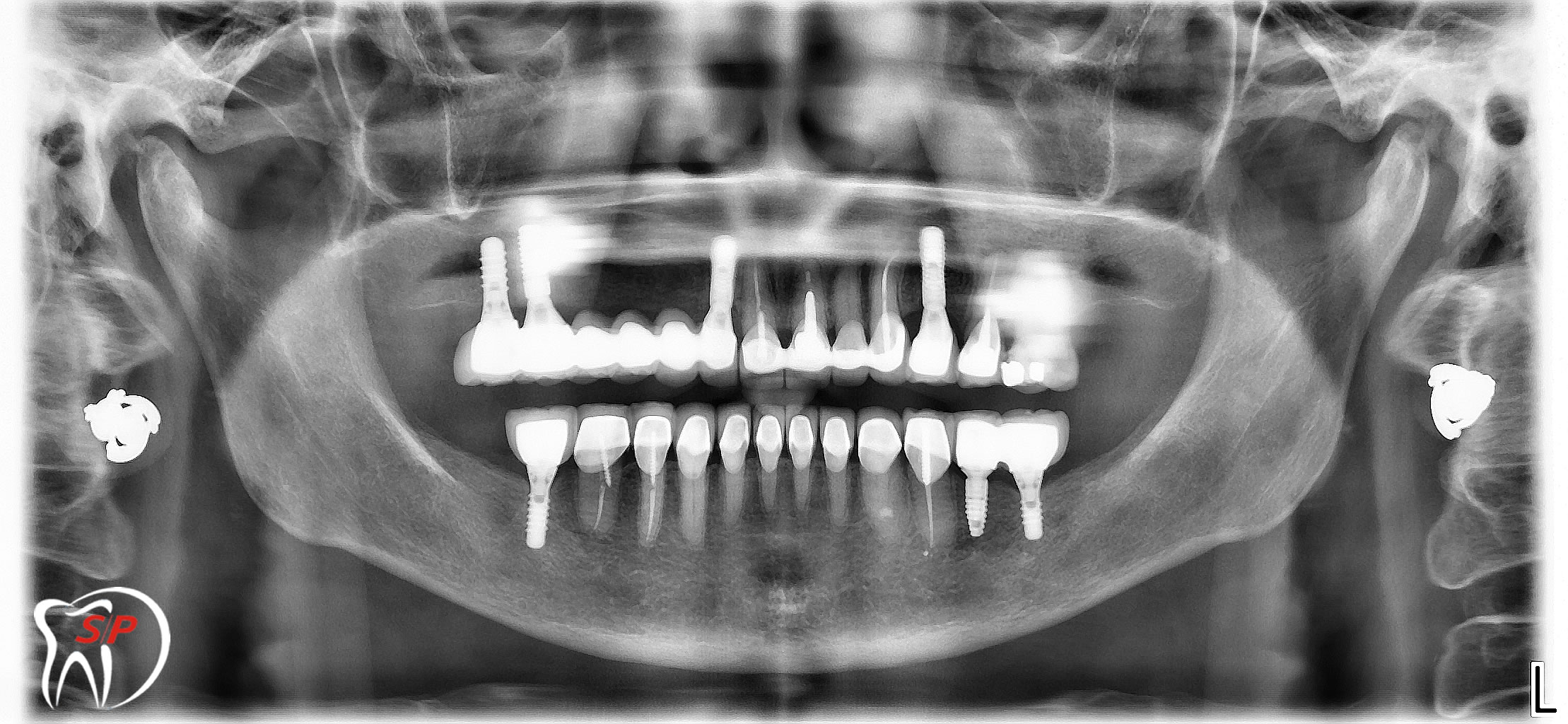 Nhiều Implant2 Implant riêng lẻ