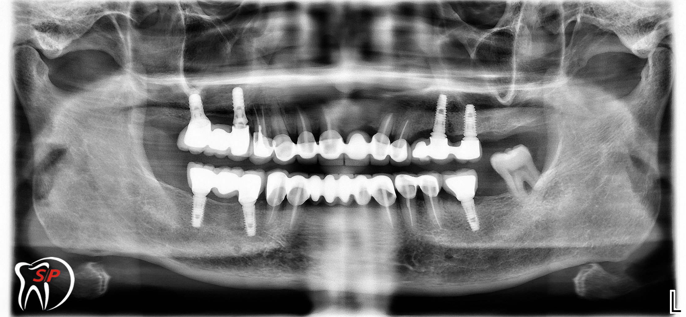 Nhiều Implant3 Implant riêng lẻ