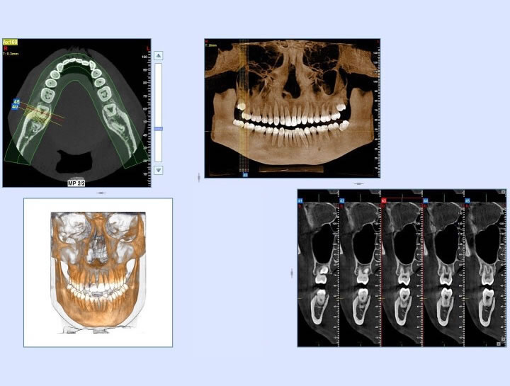 phan-mem-implant phan-mem-implant